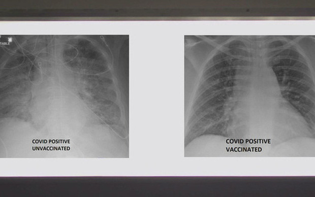 So sánh ảnh chụp phổi của b.ệnh nh.ân COVID-19 đã tiêm và chưa t.i.êm vaccine, phát hiện điều kinh ngạc